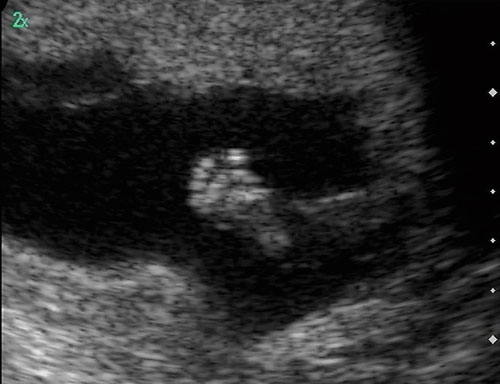 ultrasound foot
